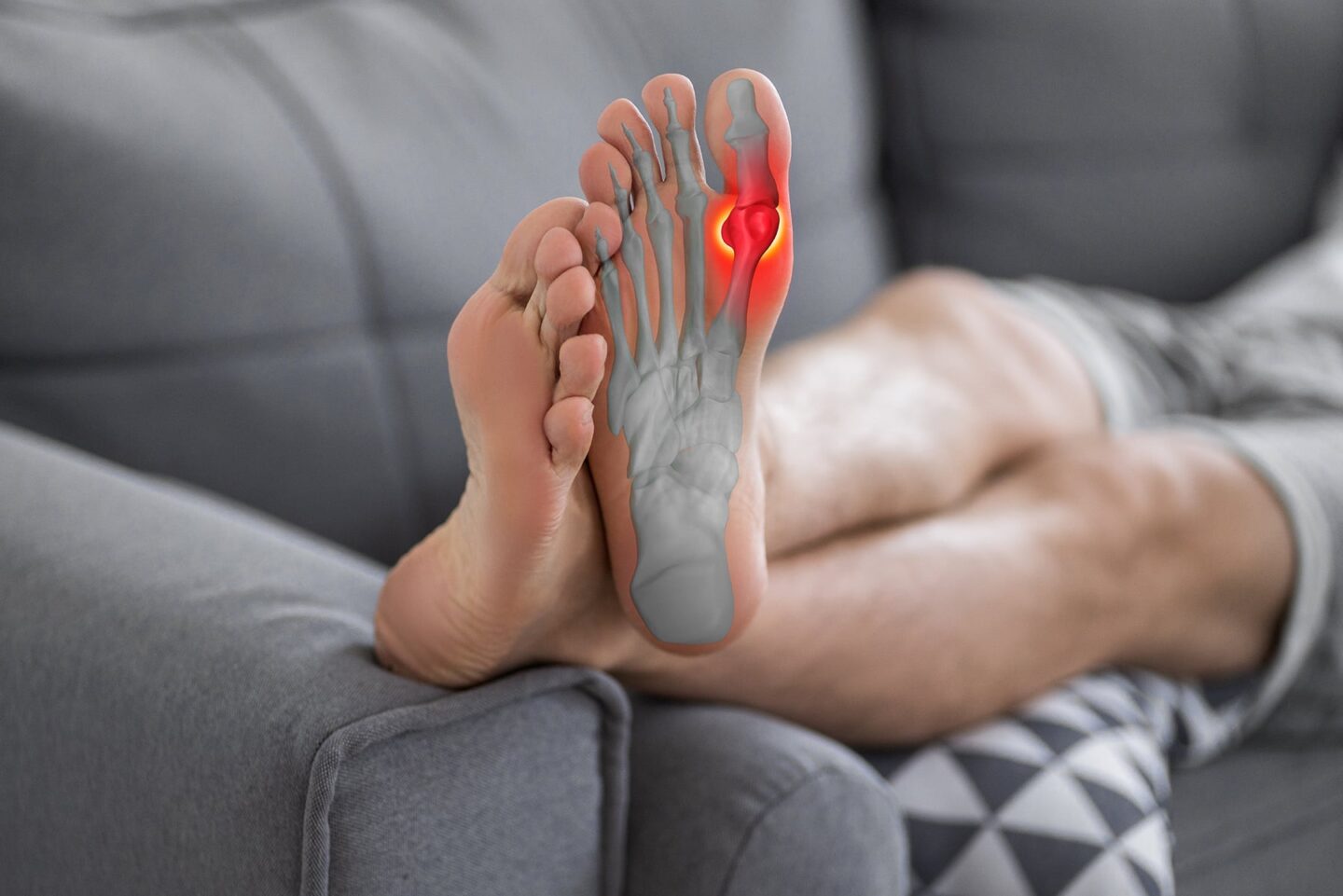 Image of feet up on the armrest of a couch, with a diagram of the bones and joints, with a red hot radiating gout flare shown